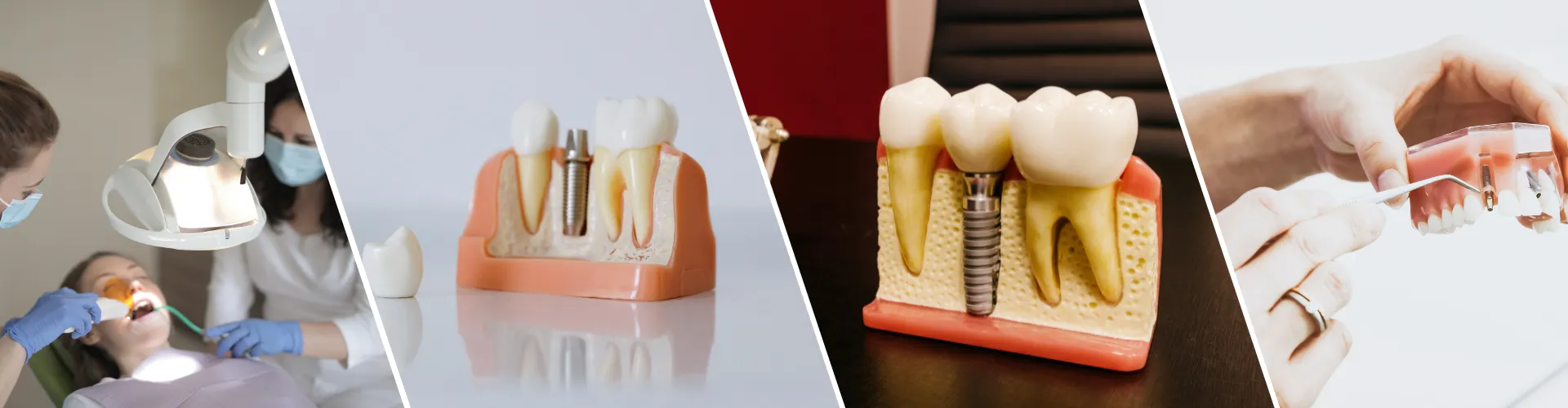 Dental Implants